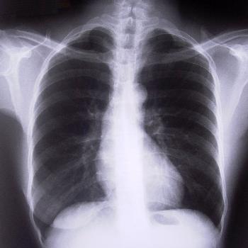 Chest X-Ray (One View)