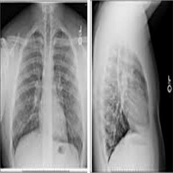 Chest X-Ray (Two View)
