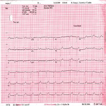 EKG (includes interpretation)